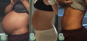 Results of postpartum girdle