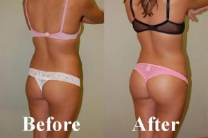 Waist training before and after